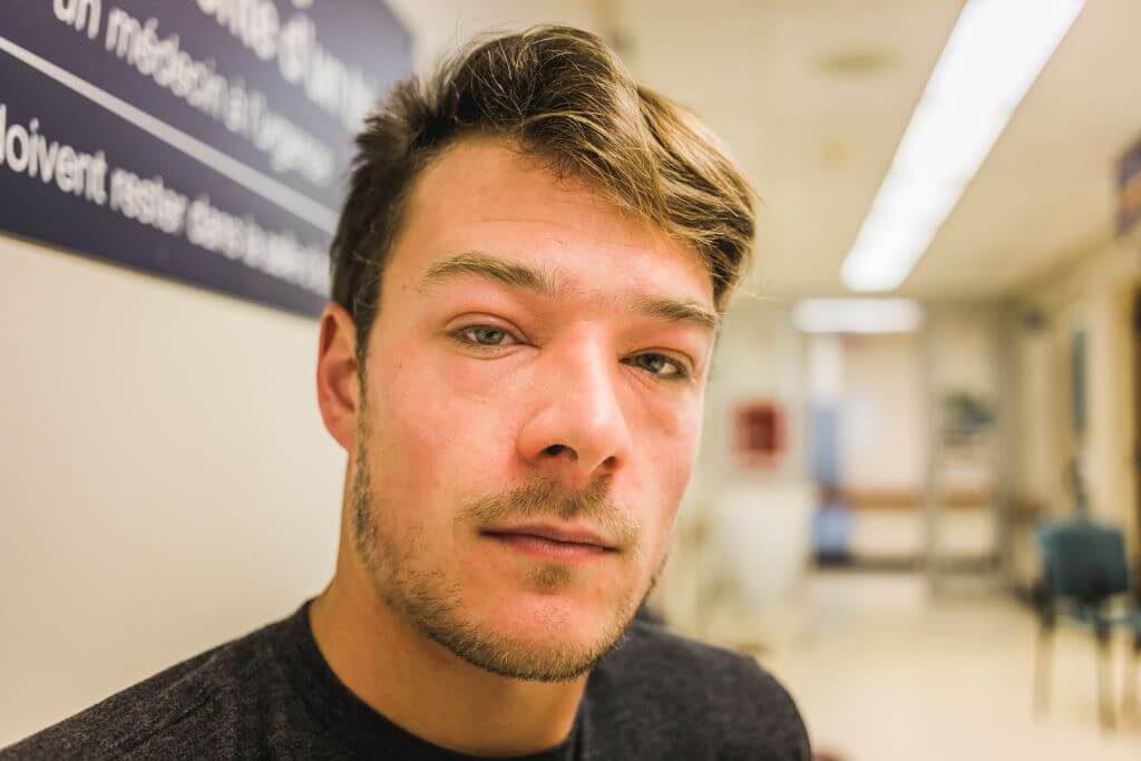 eczema